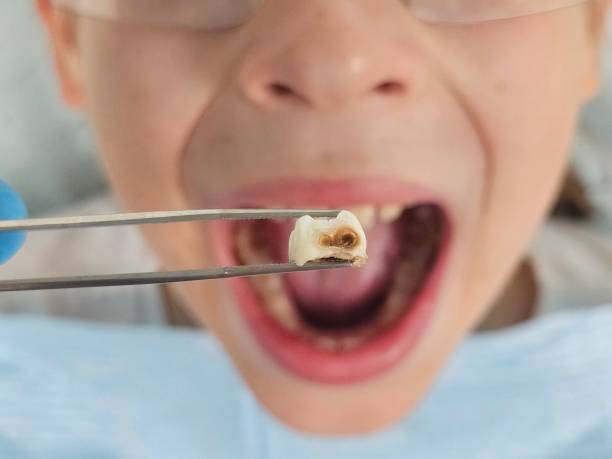 Best Emergency Tooth Extraction in Savanna, IL